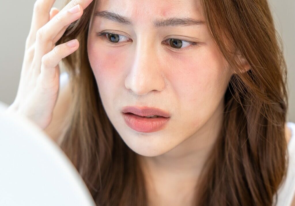 Picture of woman with makeup allergies so makeup artists can avoid lawsuits